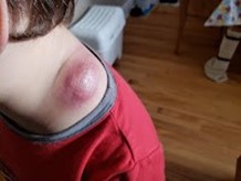 Ollie's neck, which has a large red bump that looks like a sunburn.